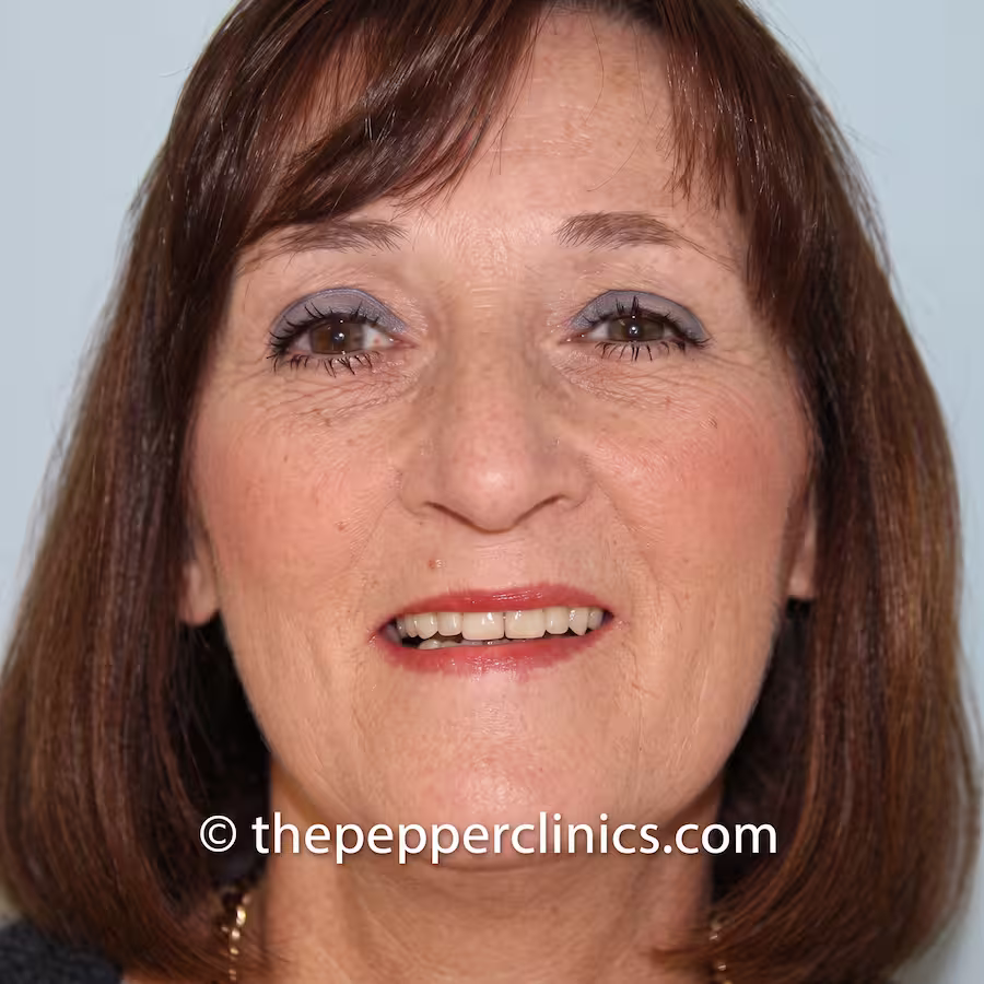 After treatment: teeth restored, even and lightened