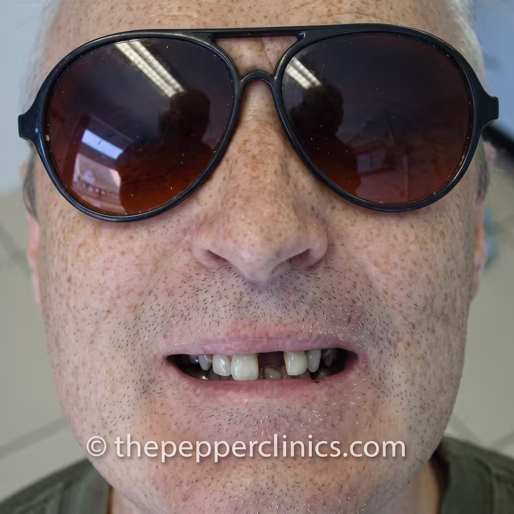 Before treatment: missing and broken upper front teeth