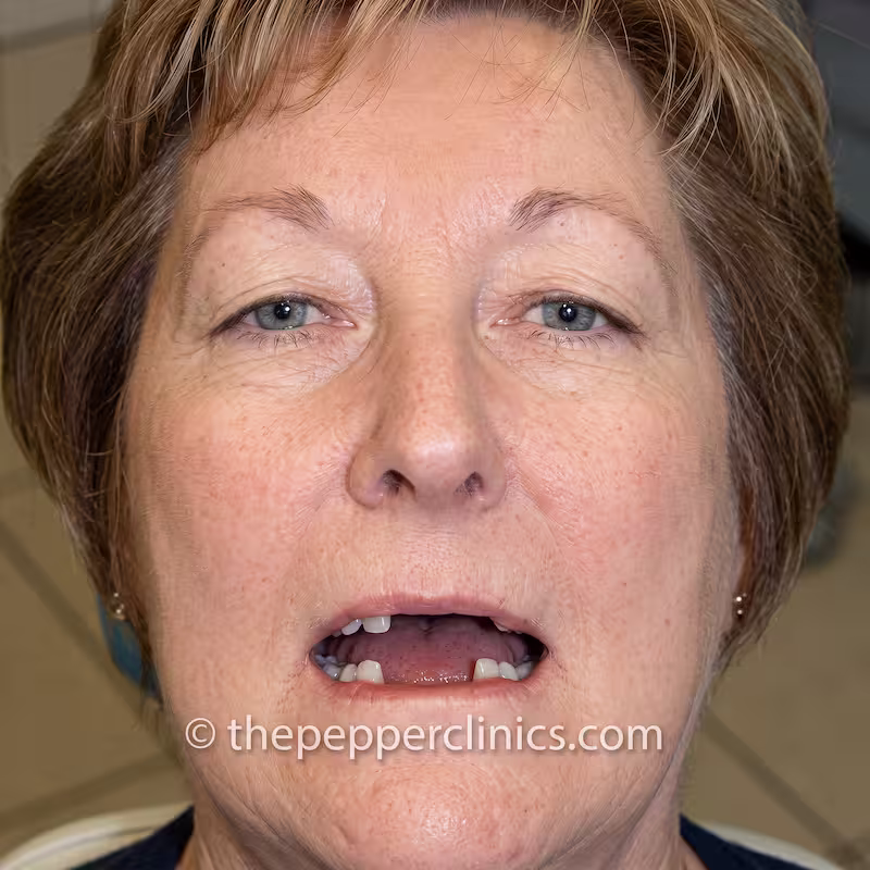 Before treatment: several missing upper teeth
