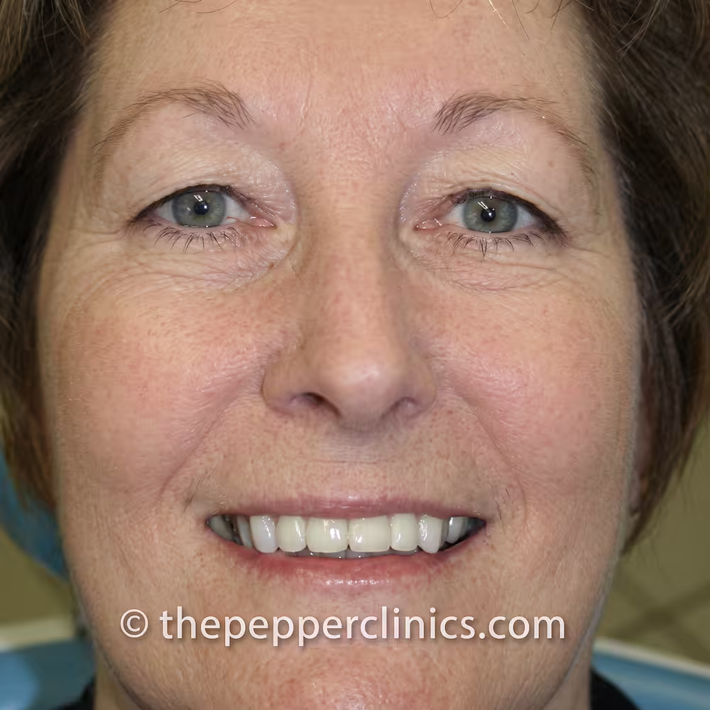 After treatment: a full, natural-looking smile